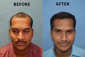 Hair Transplant Surgery Before and After Results | Hair Sure