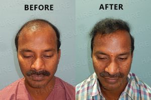 Alopecia before and after Hyderabad, hair specialist doctor near me