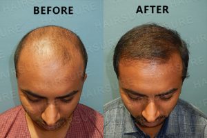 Hairline restoration before and after Hyderabad, dermbyologist Hair specialist near me