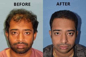 PRP before and after Hair loss Hyderabad, Best Hair fall doctor near me
