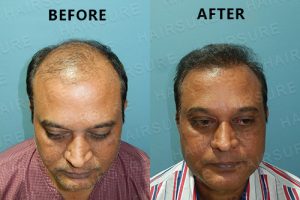 PRP Hair treatment before and after Hyderabad, best hair dermatologist near me