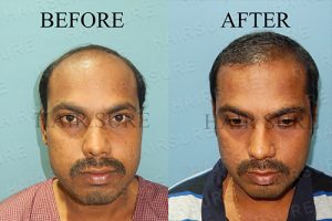 PRP Hair before and after male Hyderabad, beard specialist doctor near me