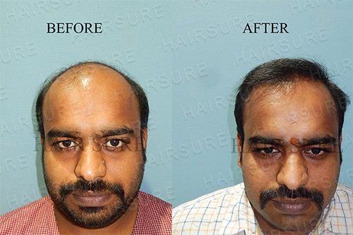 Best Surgical Hair Restoration  Hair Fixing near me  Hair Replacement   FUE  Kerala  Cochin