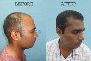 PRP before and after men Hyderabad, hair specialist doctor near me