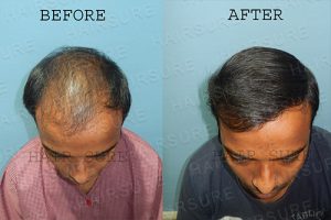 Before after propecia treatment Hyderabad, Hair restoration clinic near me