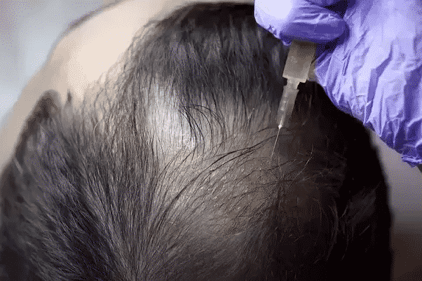 PRP therapy for Hair loss treatment in Hyderabad, hair specialist doctor near me