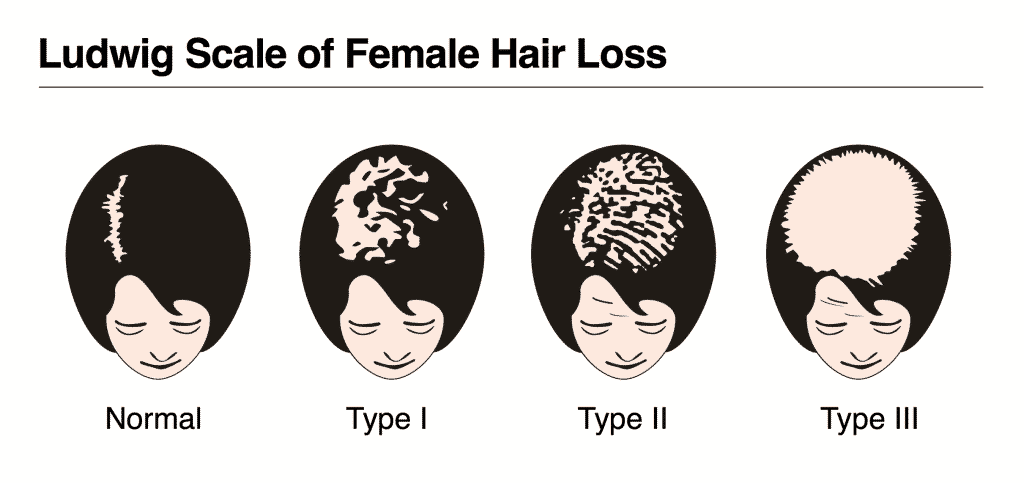 female pattern baldness scale treatment by Hair sure clinic, one of the best centre for Hair care in Hyderabad