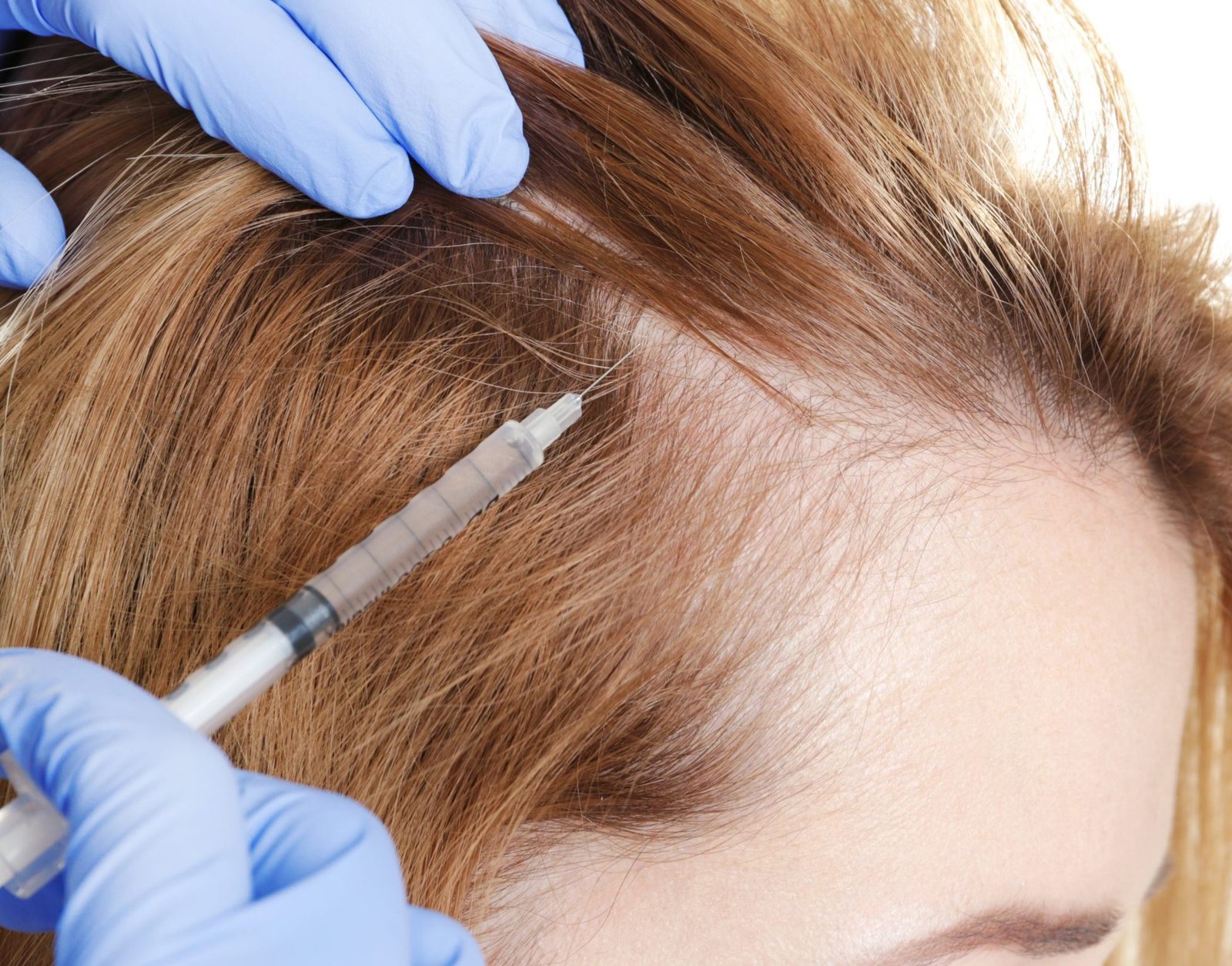 Types of Female Hair Loss And Its Treatment Hair Sure