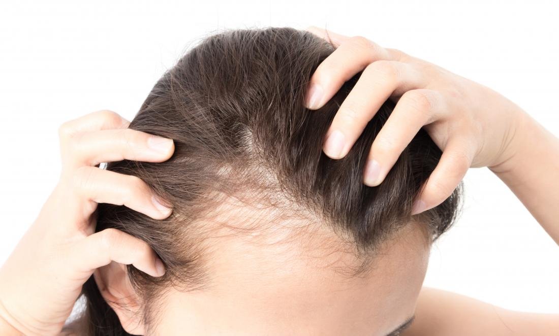 Types of Female Hair Loss And Its Treatment Hair Sure