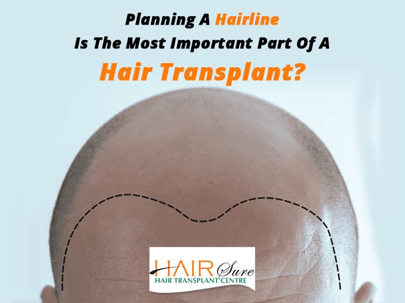 Planning A Hairline Is The Most Important Part Of A Hair Transplant? | Hair  Sure