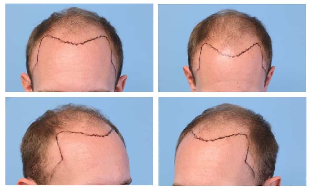 My hairline threatened my identity so much the ground felt shaky': why hair  transplants are booming | Men's hair | The Guardian