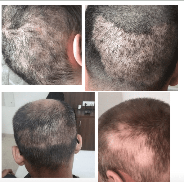 How Do You Treat Diffuse Hair Loss In The Donor Area? | Hair Sure