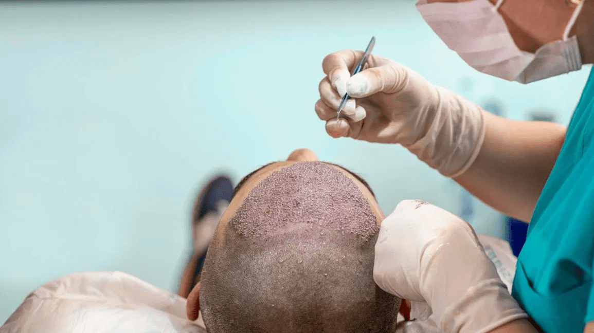 Contact Hair sure to know Hair Transplant results timeline, hair restoration near Uppal