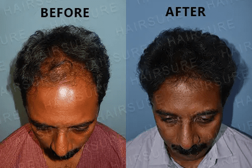 FUE hair transplant before and after Hyderabad, hair transplant around Habsiguda