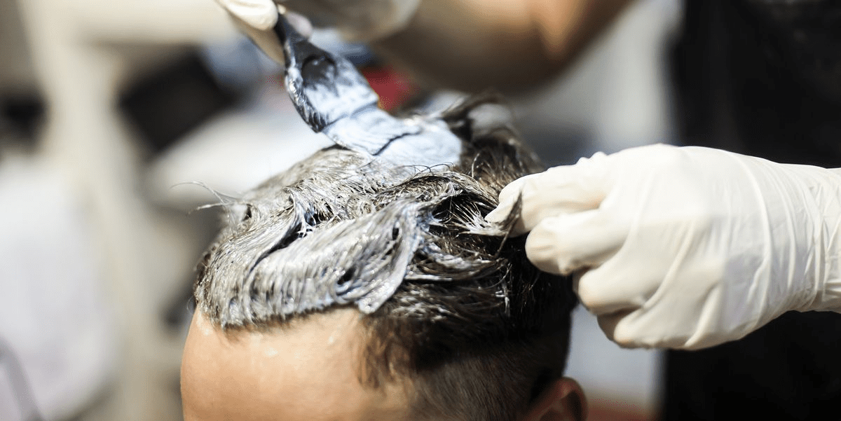 The best treatment for hair loss due to hair dye in Hyderabad, best hair transplant doctors near Uppal