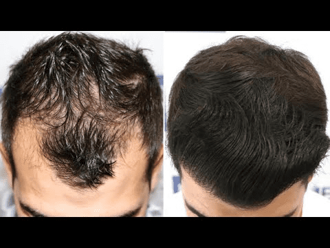 Consult Hair Transplant surgeon Hyderabad for Male Pattern baldness treatment