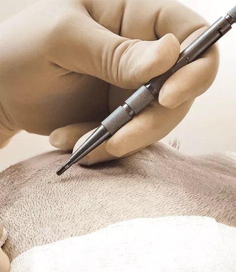 Make an appointment to know complete guide about Hair Transplantation, Best hair Transplant treatment hospital in hyderabad