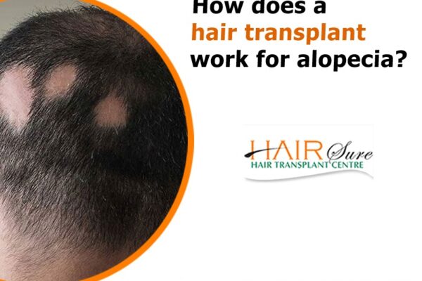How does a hair transplant work for Alopecia?