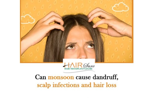 Can monsoon cause dandruff, scalp infections and hair loss