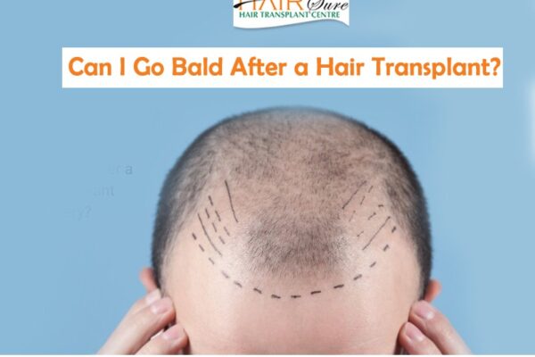Can I Go Bald After a Hair Transplant?