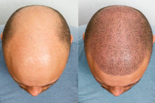 Consult Hairsure Center for hair loss treatment in hyderabad,Best Hairsure clinic in hyderabad
