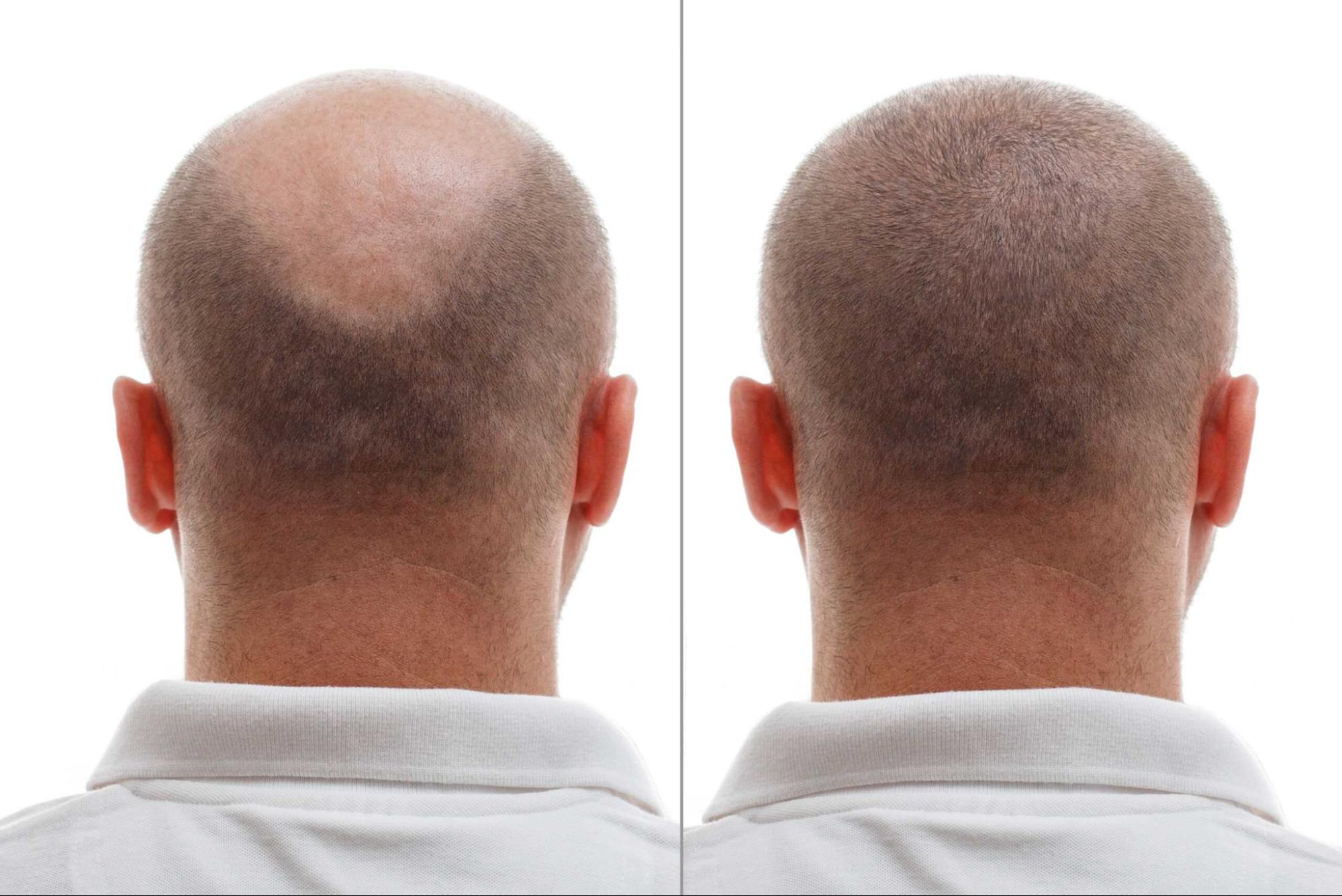 Can I Go Bald After a Hair Transplant? | Hair Sure