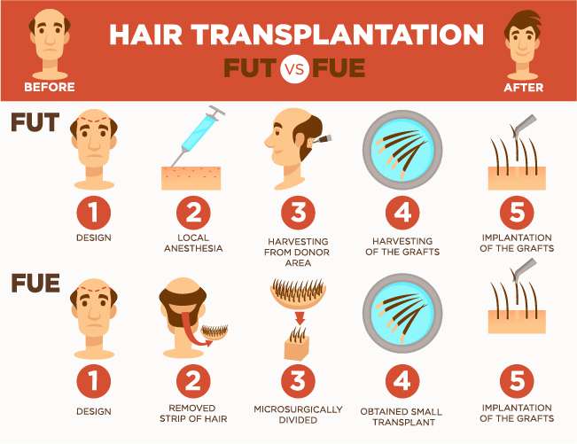 Consult Hair Transplant surgeon Hyderabad for Hair Transplant surgery near me
