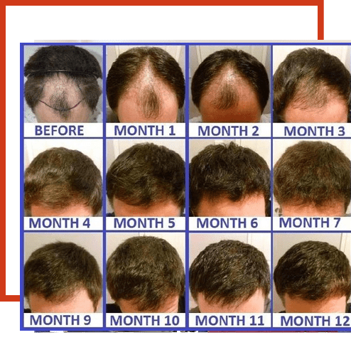 Get now Hair Treatment in Hyderabad by Top Hair Transplant Surgeon in Near me